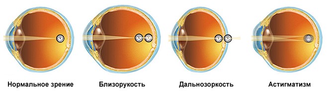 Лазерная коррекция